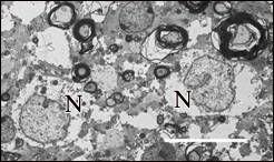 A gömbben találunk neuron perikaryonokat (N), astrocytákat (Gl) és különbözı átmérıjő myelinhüvelyes idegrostokat. Mérték: 10 µm 52. ábra.