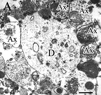 53. ábra. Majom filum FT ultrastruktúrája. Vastagabb dendrit (D) körül számos 0,5 µm mérető szinaptizáló axonvégzıdés (Ax) sorakozik (koszorú szinapszis). Mérték: 1 µm 4.
