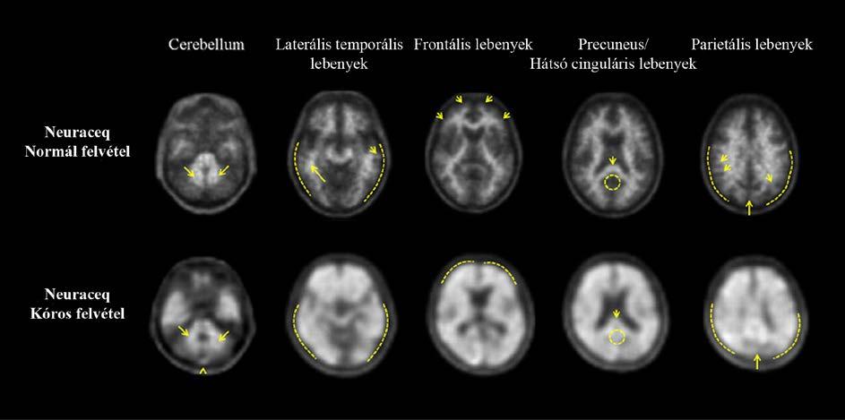 1. táblázat: A regionális kortikális radioaktív jelölőanyag-halmozás (regional cortical tracer uptake RCTU) meghatározásai Regionális kortikális radioaktív Az értékelendő állapot