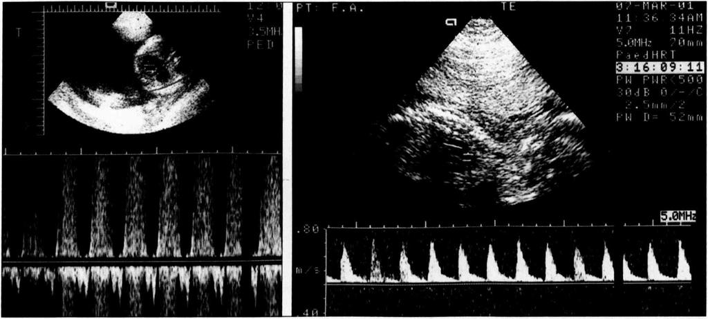 strukturális szívbetegség nélkül alakult ki súlyos CD. Tíz magzat esetében hydrops foetalis (6.