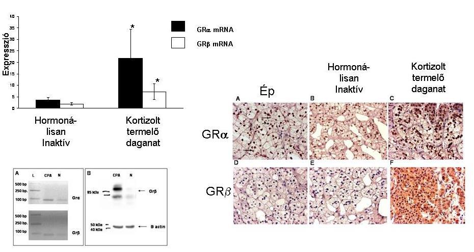 viszonyítva is mind a GRα mind pedig a GRβ fokozott expressziót mutatott a kortizolt termelő daganatokban (35. ábra).