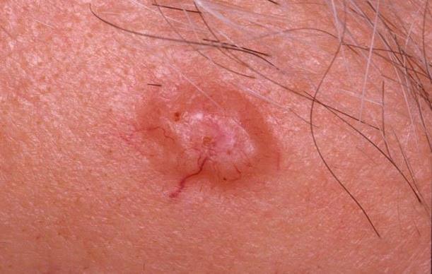Bőrelváltozások 3. Basalioma (carcinoma basocellulare) alapi sejtes bőrrák Kiemelkedő, a bőr basalis sejtrétegéből kiinduló, szövettanilag egyértelműen rosszindulatú, progresszív szövetburjánzás.