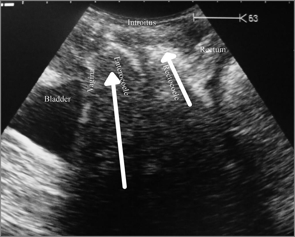 Vaginalis ultrahang Cystocele Rectocele, Enterocele