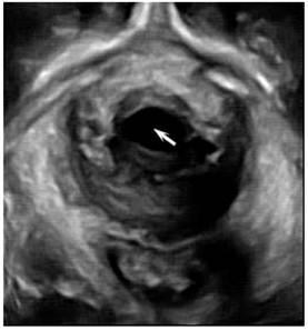 3D UH Cystocele (arrow) on 3D ultrasound imaging in a woman