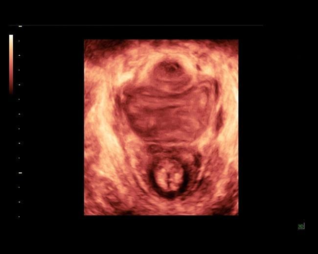 4829 Research Paper Three-dimensional Ultrasound Appearance of