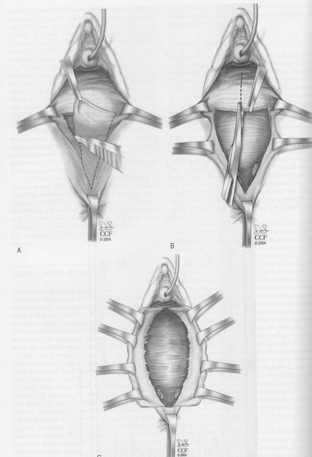 Colporrhaphia posterior Hátulsó