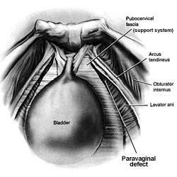 Laparoscopos paravaginalis repair