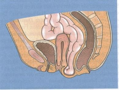 hüvelyfal süllyedése) Uterus vagy csonk