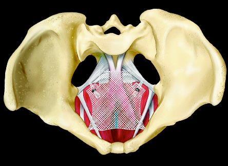 Elevate Anterior & Apical Prolapse Repair