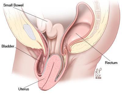 Prolapsus uteri Gyakran mellső és hátsó hüvelyfali