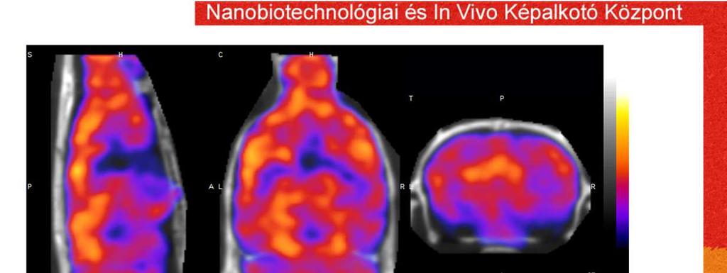 Az agyszövetbe bejutó molekulák közül a klinikai gyakorlatban a Tc-HMPAO a leggyakrabban használt molekula.