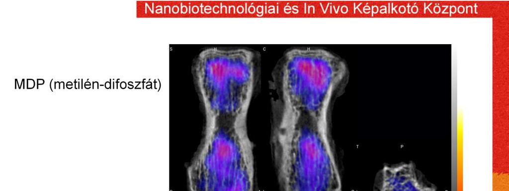 A csont scintigráfia egy nagyon elterjedt vizsgálat mind onkológiai, mind csont anyagcsere és törés