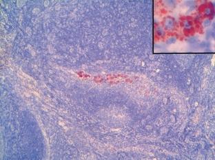 5. ábra. A metastaticus melanomasejteket a HMB-45 immunhisztokémiai reakció az esetek többségében kiemeli a negatív háttérbôl (HMB-45 immunhisztokémia, x40).