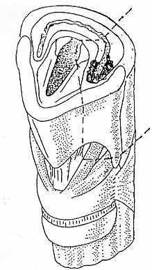 parciális pharyngectomia parciális supracricoid