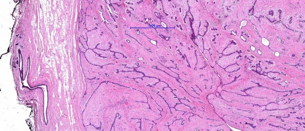 Fibroadenoma: Két komponens: fibrosus stroma +