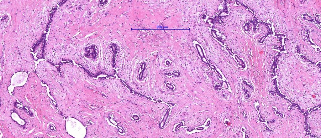 Fibroadenoma: Két komponens: fibrosus stroma +