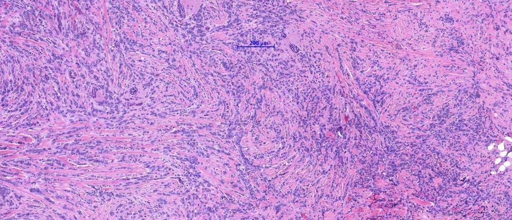 Invazív lobularis carcinoma Discohesiv sejtek