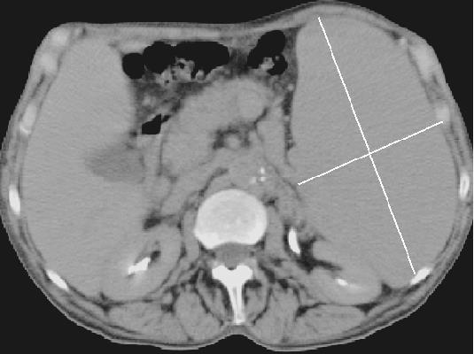 Splenomegalia: főbb tünetek a has b.