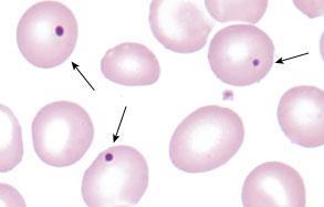 Hypersplenia pl. cirrhosis hepatis, Felty syndr.: splenomegalia perif. vérben cytopenia/k hypercellularis csontvelő Hyposplenia pl.