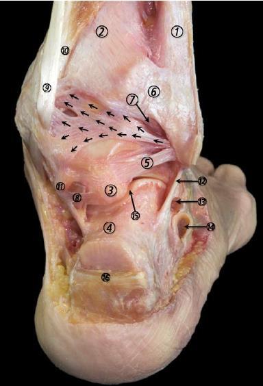 Articulatio talocruralis Lig. talofibulare posterius (5) Fibula (1) Tibia (2) Proc. tali, tuberculum laterale (3) Proc.