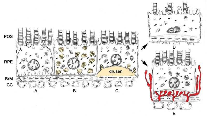 stress Retinal pigmentepithelium ageing(no mitosis)