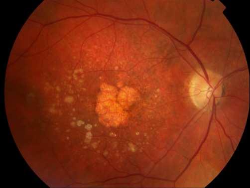 exsudative(15%) Chorioidal Neovascularisation(CNV)