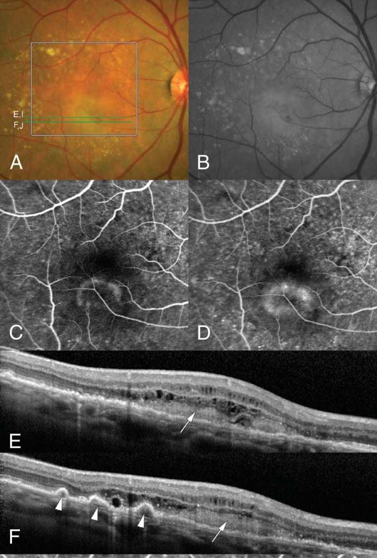 9% overall Klein et al. Ophthalmology 2007; 114: 253-262 Klein et al. Ophthalmology 1992; 99: 933-943 Kahn et al.