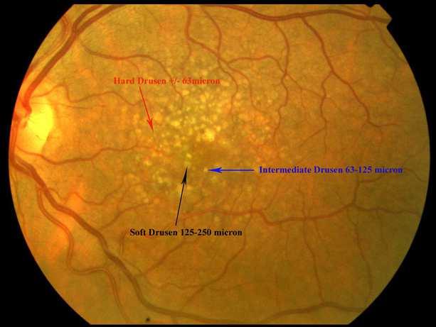 Ophthalmology 2007; 114: 92-98 Mitchell et al.