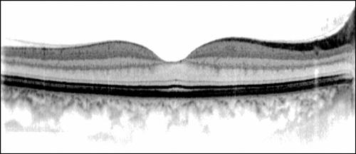 Normal Dry AMD Wet