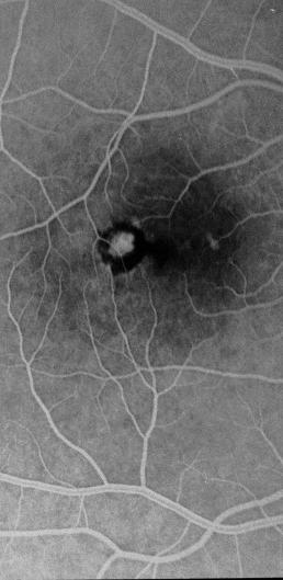 loss unavoidable Photodynamic therapy(pdt) Selectivephotothrombosisof