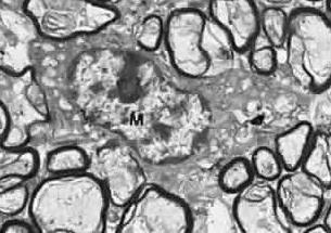 sejt aktivációhoz szükség ko-stimuláció szignálokért felel CD32: sejtfelszíni antigén, hfcrii (Fc-gamma R2), IgG Fc részének leggyakoribb receptora CD16: low affinity Fc receptor, hfcriii (Fc-gamma