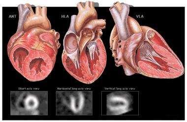 The reoriented SPECT slices of the left ventricle myocardium (Updated: Feb 24,