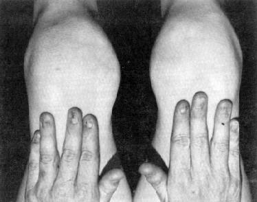Az egyedfejl dés genetikai szabályozása 88 (3) Differenciáció a dorzális-ventrális irányban A fels -alsó (tenyér-kézfej, lábfej-talp) irányú differenciációt az az ektoderma határozza meg, amely a