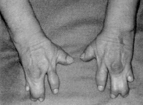 Az egyedfejl dés genetikai szabályozása 87 11.22. ábra. Contergan bébik, és split hand split foot szindróms kéz, illetve lábfej.
