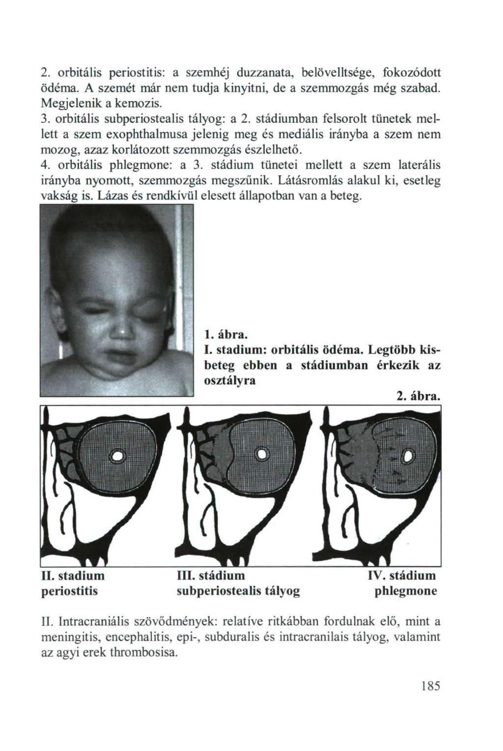 2. orbitális periostitis: a szemhéj duzzanata, belövelltsége, fokozódott ödéma. A szemét már nem tudja kinyitni, de a szemmozgás még szabad. Megjelenik a kemozis. 3.