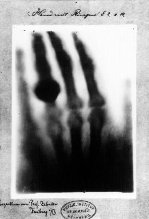 Hand mit Ringen: print of Wilhelm Röntgen's first "medical" x-ray, of his