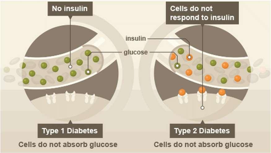 Osztályozás 1-es típusú diabéteszben (T1D) a béta sejtek pusztulása miatt az inzulintermelés teljesen megszűnik, hátterében leggyakrabban autoimmun folyamat áll.