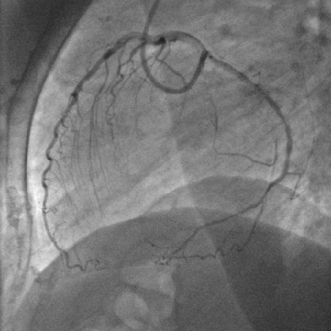 Contrast injection S D S D S D S D Time Heart cycle (S: systole) (D: diastole) Subtraction Figure 2. Phase-matched cardiac DSA.