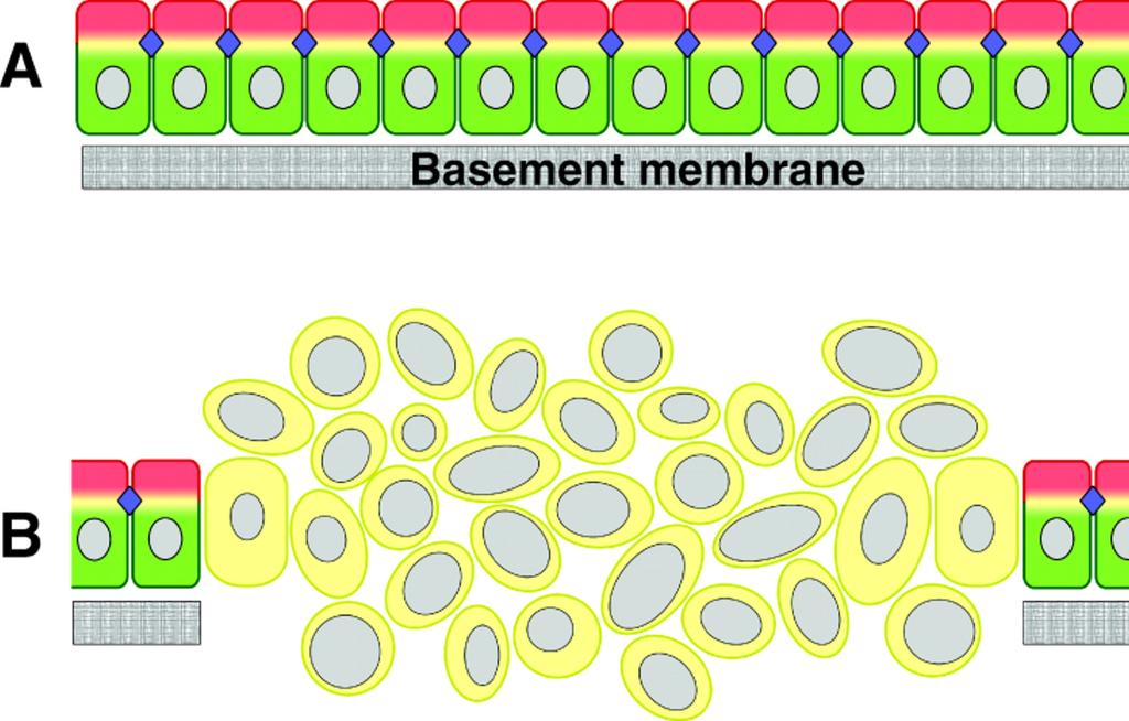Aberráns sejtmag morfológia (alak, méret, kromatin) Aberráns mitózisok (sok osztódás, atípusos osztódás)