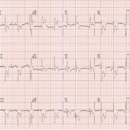 Non-ST-Elevation Acute Coronary Syndromes: A Report of the