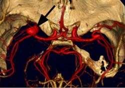 angiogram shows an