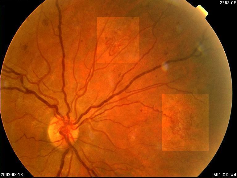 Proliferatív retinopathia n Neovascularisatio NVD/NVE Papilla predilectios hely, mert itt nincs MLI n Részleges hátsó