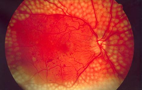 A proliferatív diabeteses retinopathia kezelése n