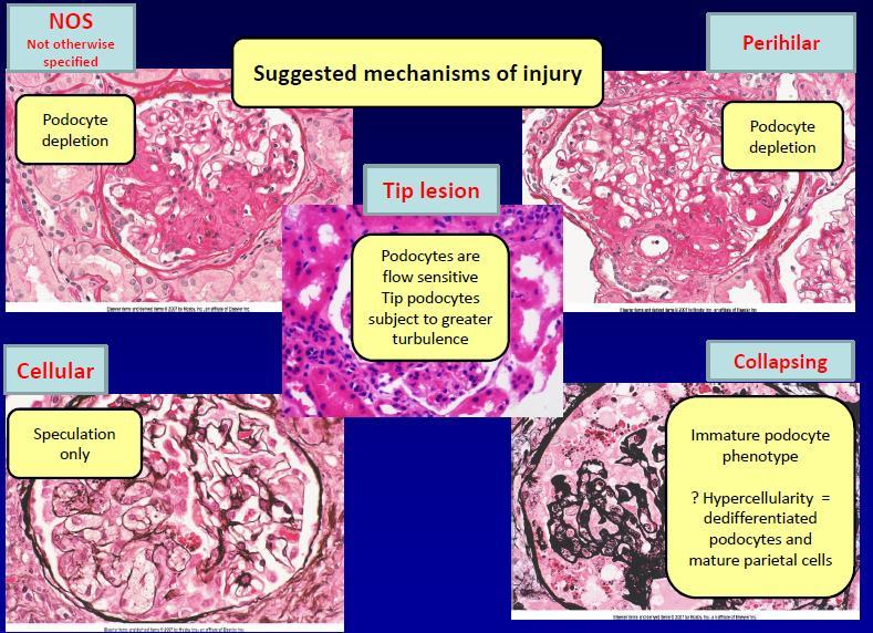 Az FSGS