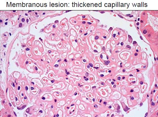 A membranosus nephropathia (MN) Etiológia: NS 30 % felnőttkorban Idiopátiás podocyta neutrális