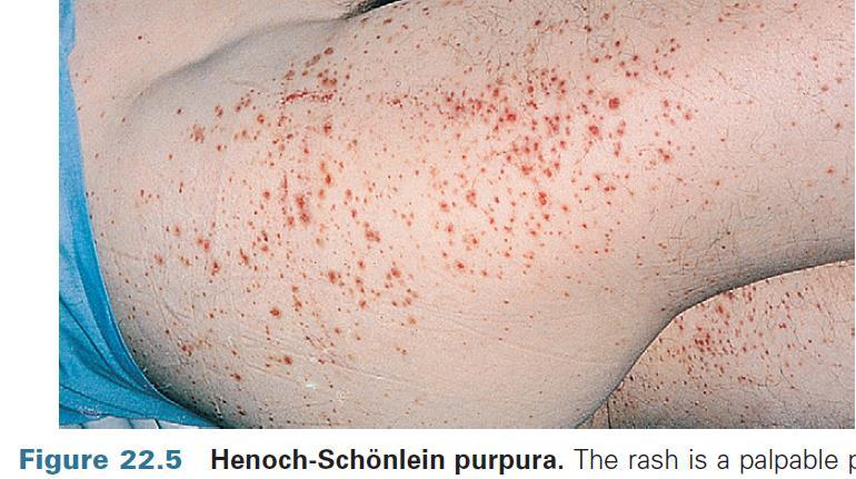 Systemás vasculitis Henoch-Schönlein purpura Gyermekkorban spontán remissio