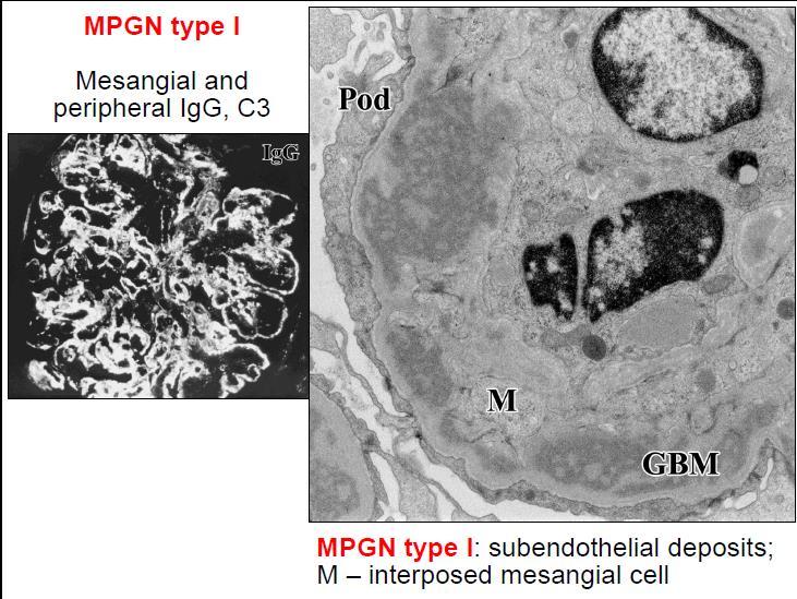 A membranoproliferatív GN