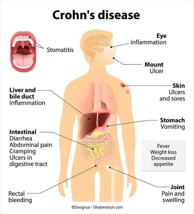 Crohn-betegség 80%-ban vékonybél érintettség Klinikai tünetek: Hasi fájdalom Hasmenés: Folyadák