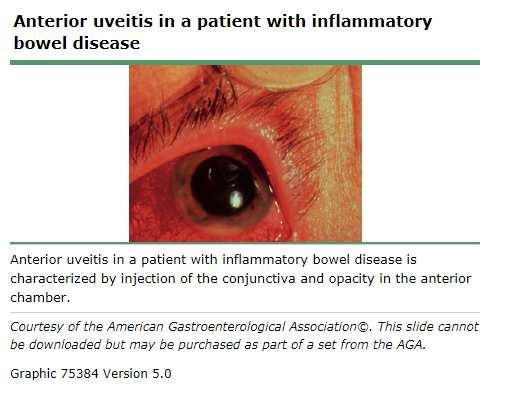 uveitis,