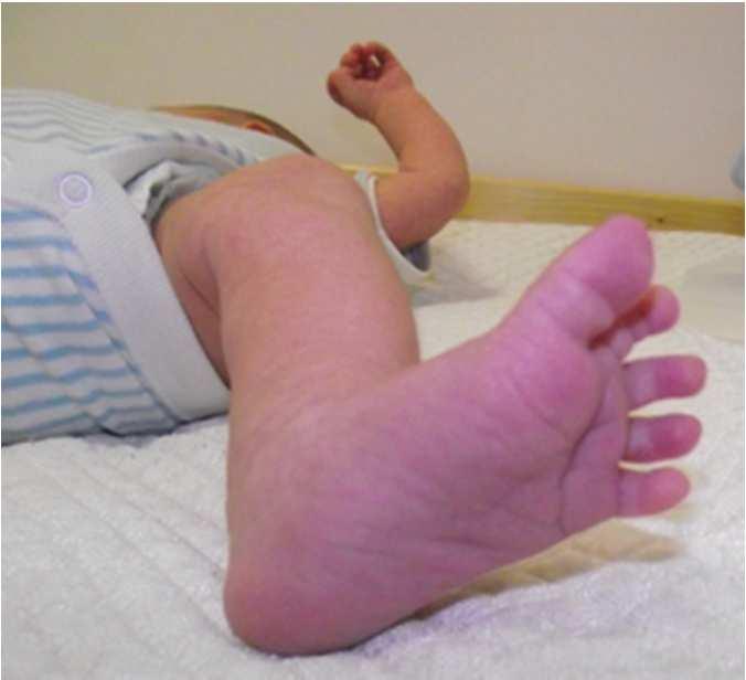 Újszülöttek szűrése tandem tömegspektrometriával Veleszületett anyagcsere rendellenességek keresése.